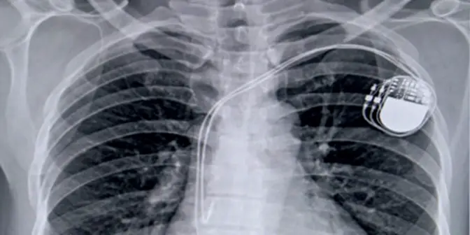 Cara Kerja Alat Pacu Jantung: Panduan Lengkap untuk Memahami Mekanismenya