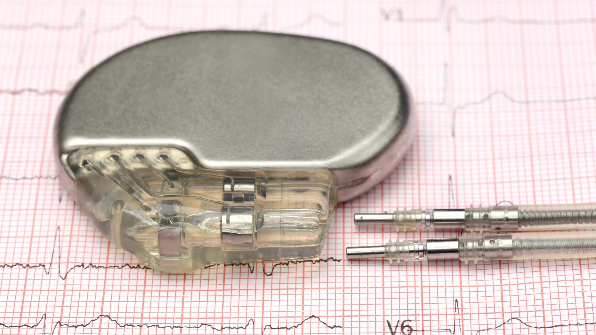 Apa itu Alat Pacu Jantung?