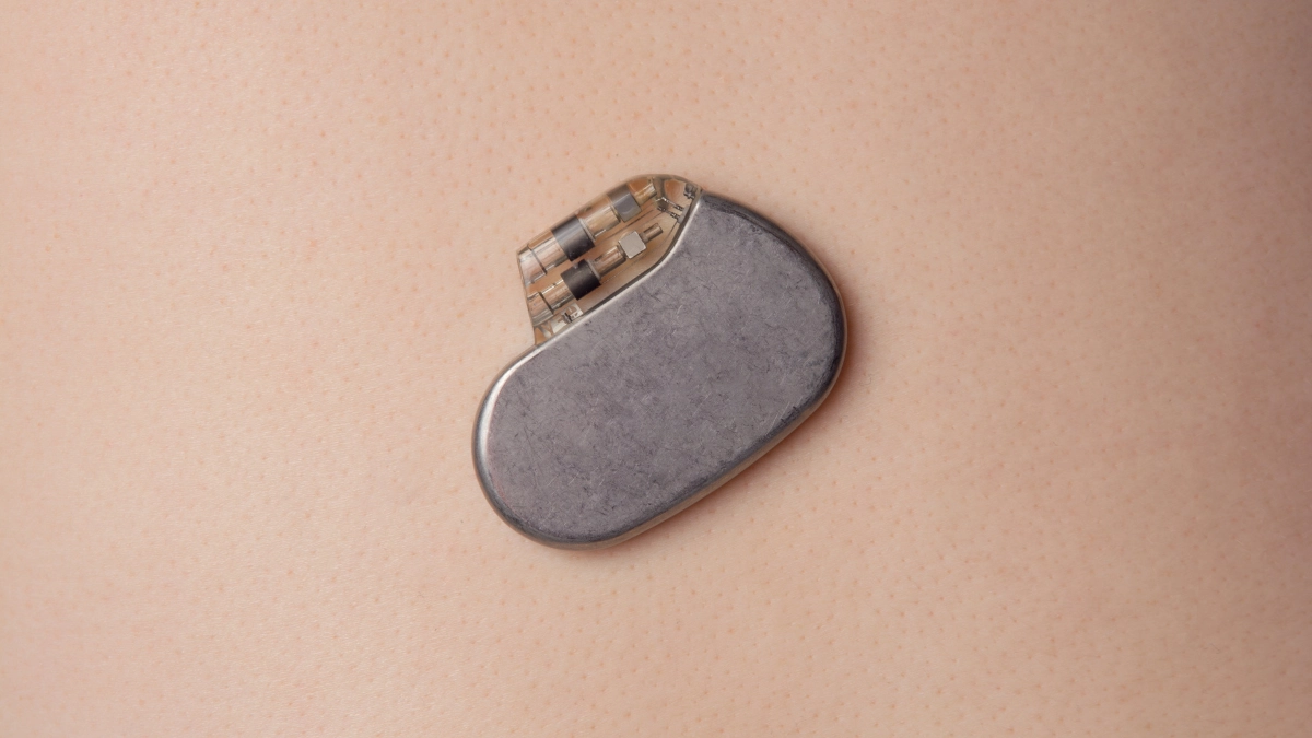 cara kerja alat pacu jantung - Narmadi.co.id