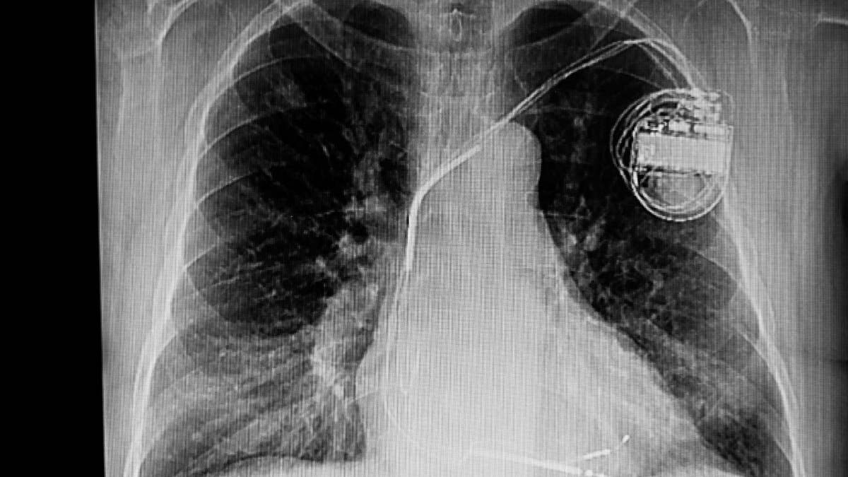 Cara Kerja Alat Pacu Jantung