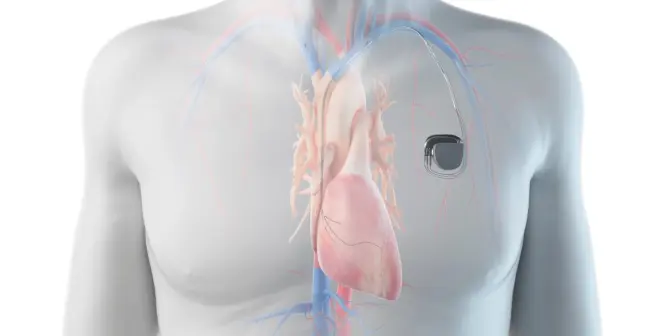 6 Jenis Alat Pacu Jantung yang Perlu Anda Tahu